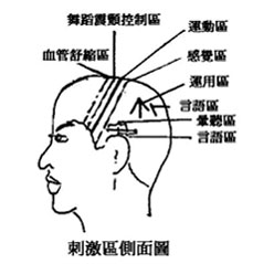 >【現代醫案】老人痴呆症的預防及頭皮針治療
