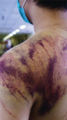 元朗有民眾被白衣暴徒打得傷痕累累。（AFP）