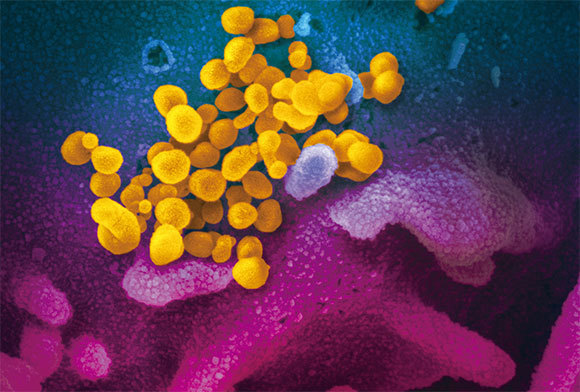 美國國家過敏和傳染病研究所2月11日發表，黃色為掃描透射電子顯微鏡下的新冠病毒，藍色和紫色是皮膚。樣品來自美國一個感染了新冠病毒的病人。（AFP）