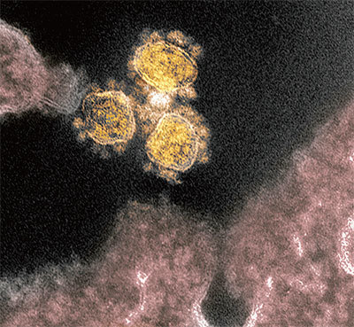 最新研究發現，肆虐全球的中共病毒已出現明顯變異，更容易入侵人體，傳染力增加很多倍。圖為SARS-CoV-2（圓形金物體）的透射電子顯微圖。（AFP）