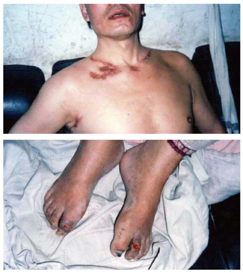 2002年9月至2004年9月王良均在貴州都勻監獄被殘酷迫害留下的傷痕。（明慧網）